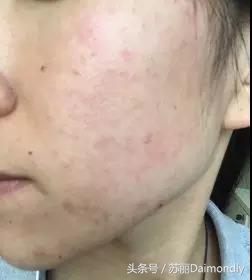 不伤害原则护理,不伤害皮肤的项目