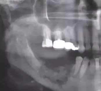 服用双膦酸盐类药物拔牙,双膦酸盐用药期间拔牙的危害