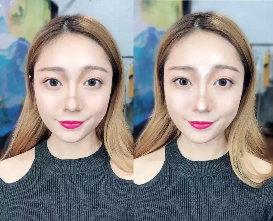 蒜头鼻怎么改变鼻型,蒜头鼻厚鼻翼怎么矫正