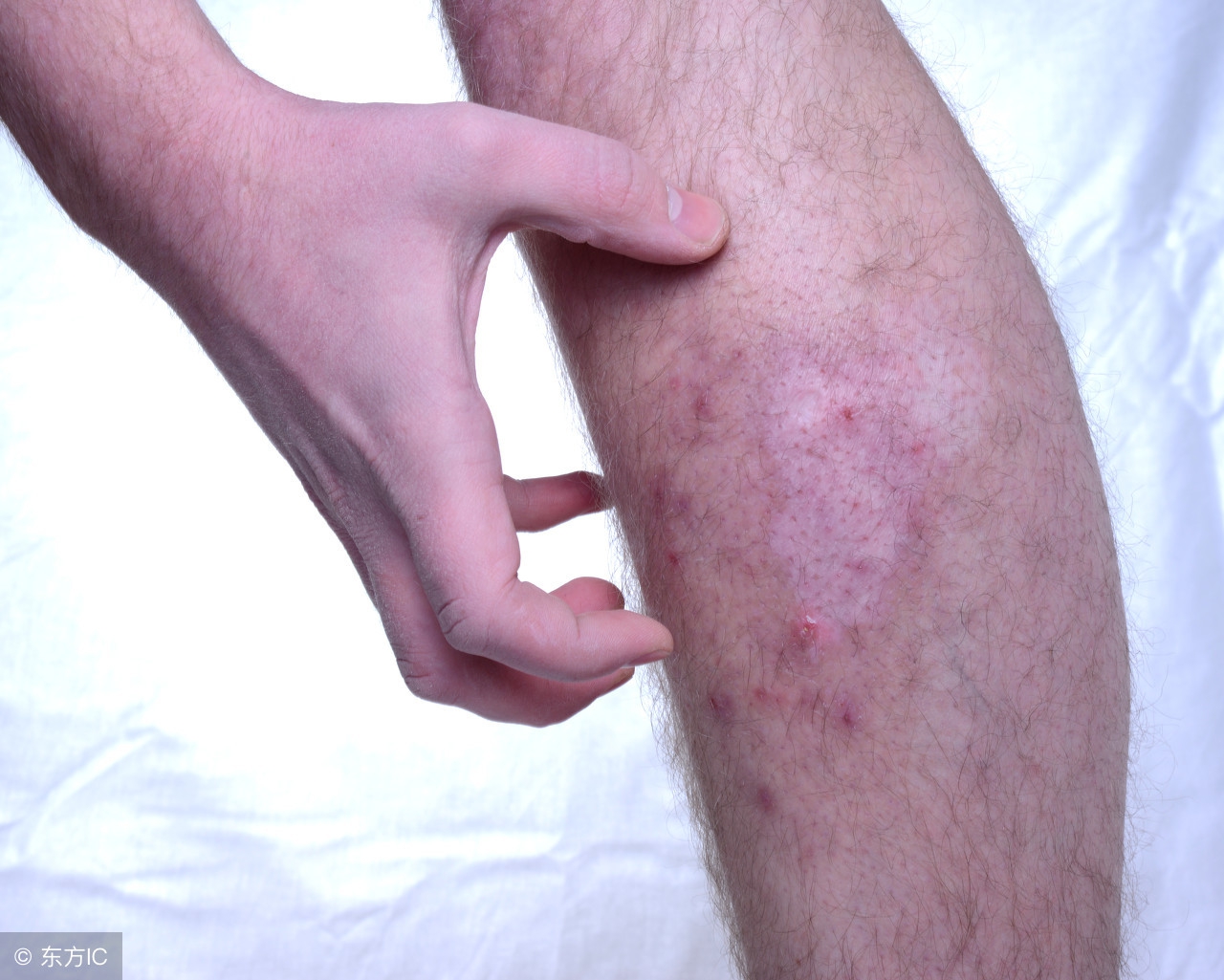 牛仔裤过敏事件,牛仔裤穿了过敏怎么回事