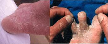 治疗足癣烂脚丫用什么药 (手癣足癣药物)