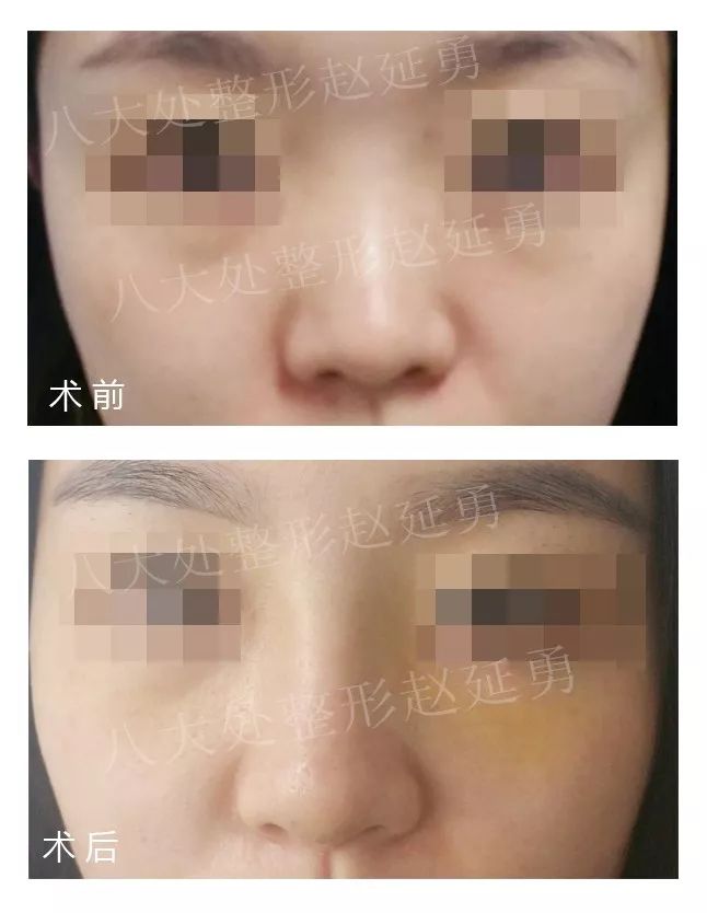 隆鼻手术后会不会一碰就变形,隆鼻术后假体移位怎么办