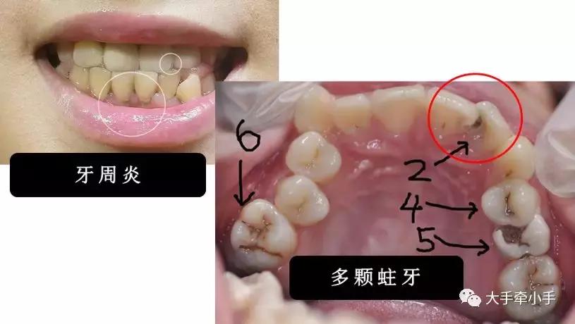 牙齿不齐矫正好还是做牙冠好,牙齿不齐矫正1个月的变化