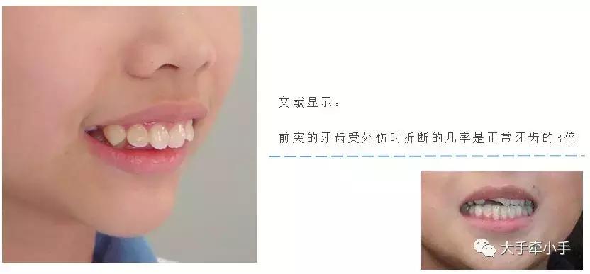 牙齿不齐矫正好还是做牙冠好,牙齿不齐矫正1个月的变化