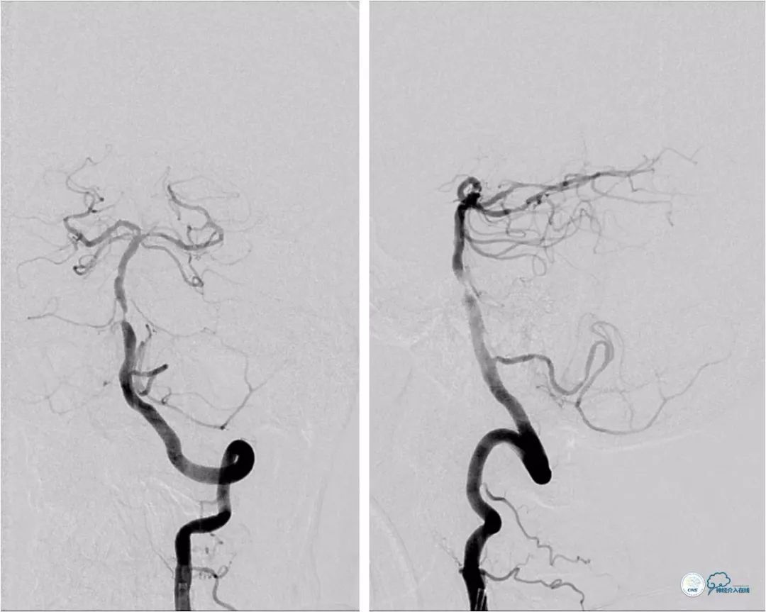 天坛周记｜左椎动脉开口及基底动脉串联狭窄血管内介入治疗1例