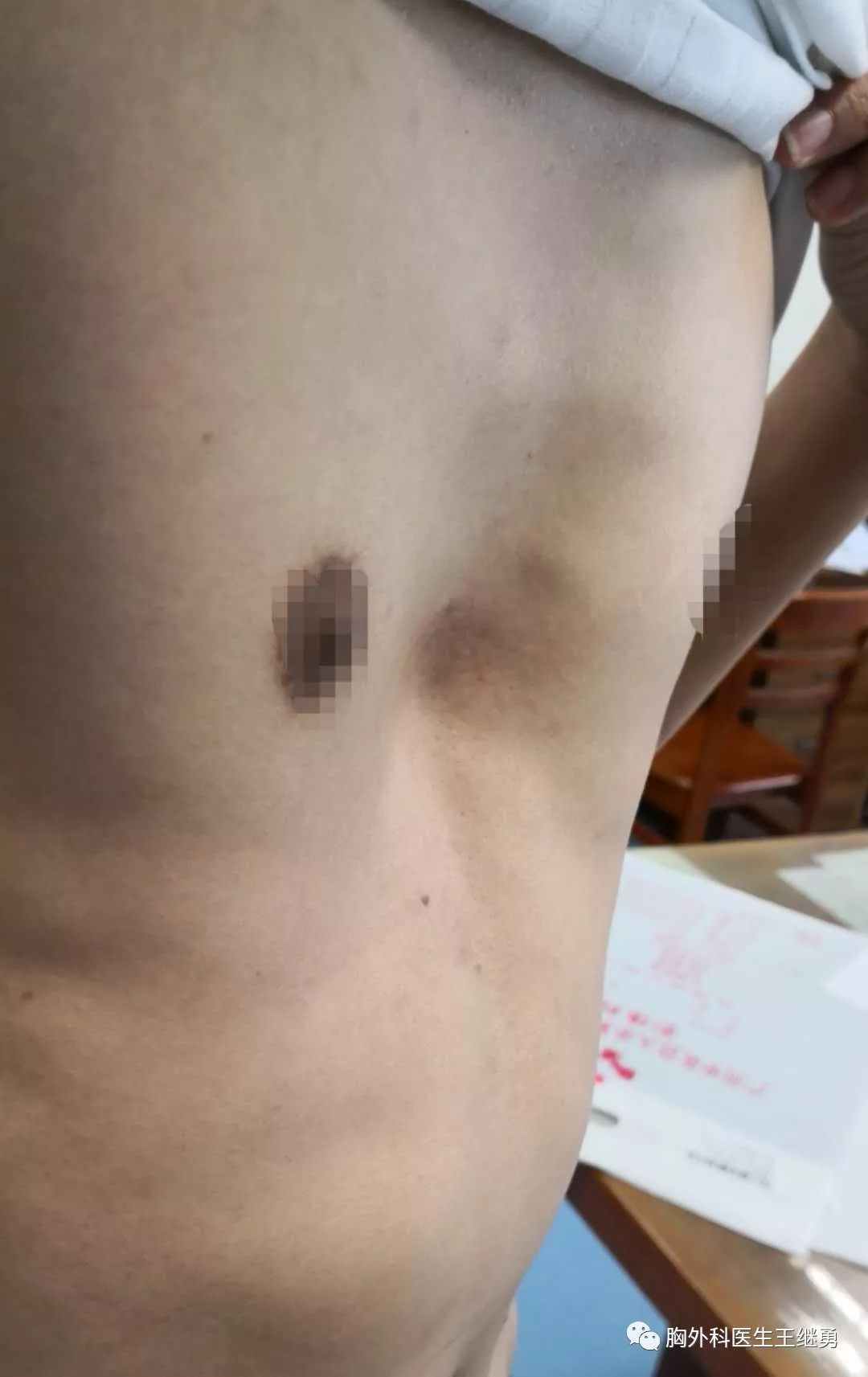 女性漏斗胸的最佳治疗方法,漏斗型胸部怎么改善