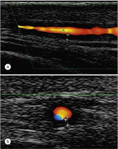 老年不明原因发热,老年人无症状发烧是怎么回事