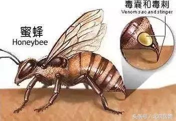 被蜂蜇伤的急救处理,被蜂类蜇伤如何急救课件