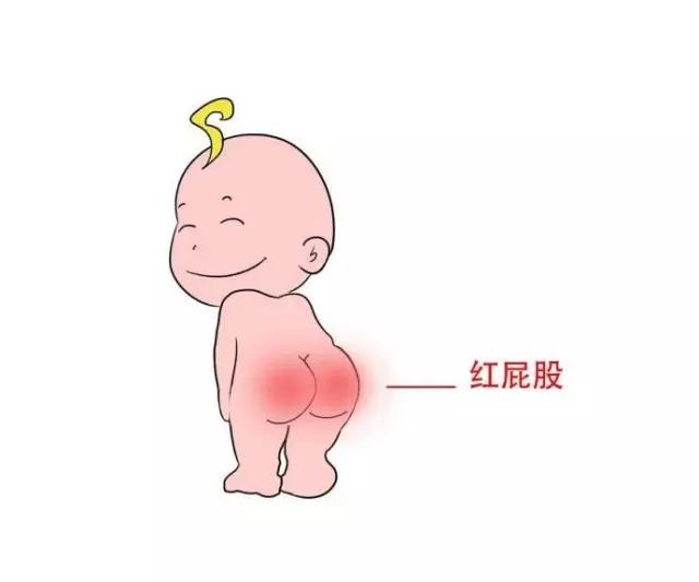 天气热了孩子红屁屁,天冷了宝宝红屁屁怎么快速消除