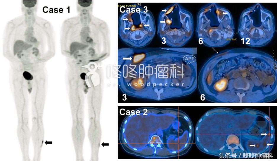 pd-1治疗肿瘤能达到治愈吗,pd-1治疗肿瘤未来进展