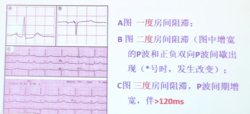 「CHC2018」郭继鸿：心电学进展2018