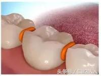 整牙全过程解说,整牙亲身经历15天