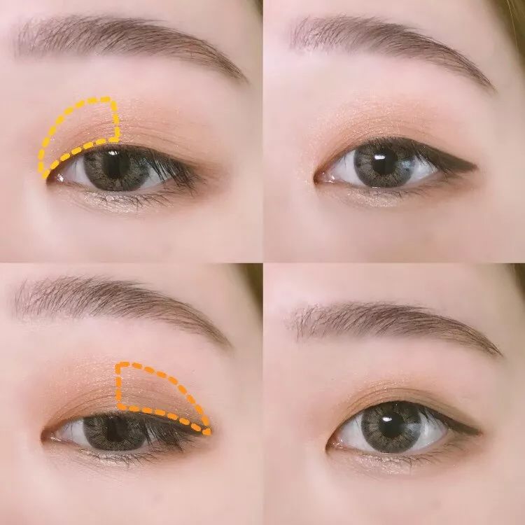 为什么三庭五眼眼距宽,眼距宽怎么改善做什么手术