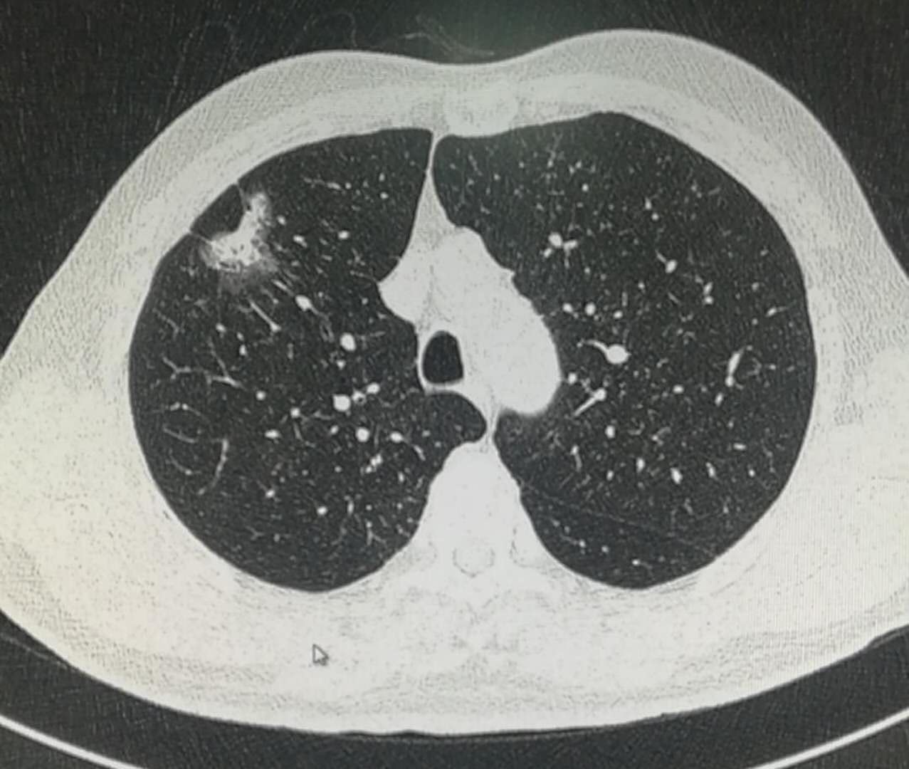 磨玻璃肺结节手术后需要化疗吗,2.5厘米肺结节微创手术后要化疗吗