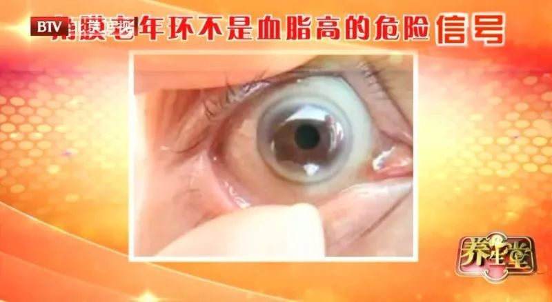 眼角血脂斑怎么消除,眼角长什么说明血脂高