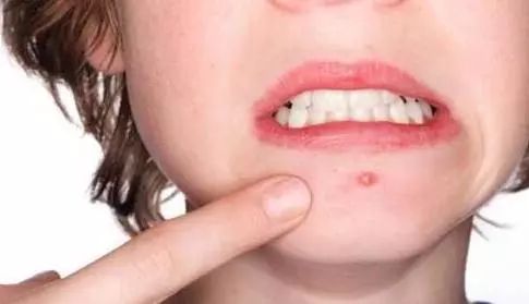 食疗内调痘痘,药食同源祛痘痘中药