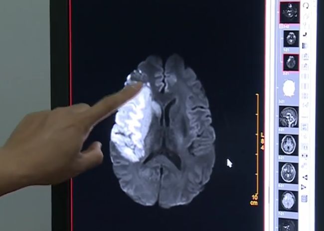 夫妻俩亲热之后，老公头晕无法动弹，医生：这类人群要定期检查！