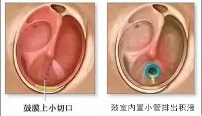 早上睡醒耳朵里有水是怎么回事,耳朵感觉有水但是干的怎么回事