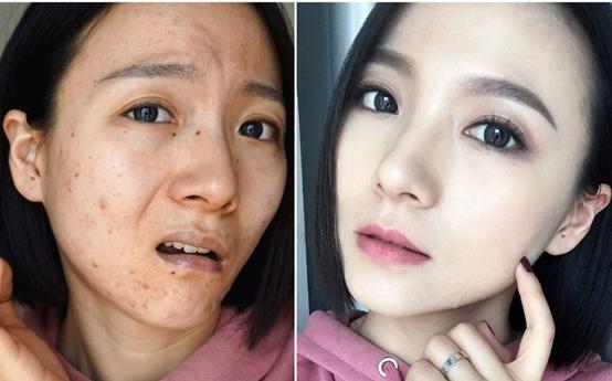 痘肌瑕疵皮的救星和灾星！最好用的鲜有人知，最难用的却被推