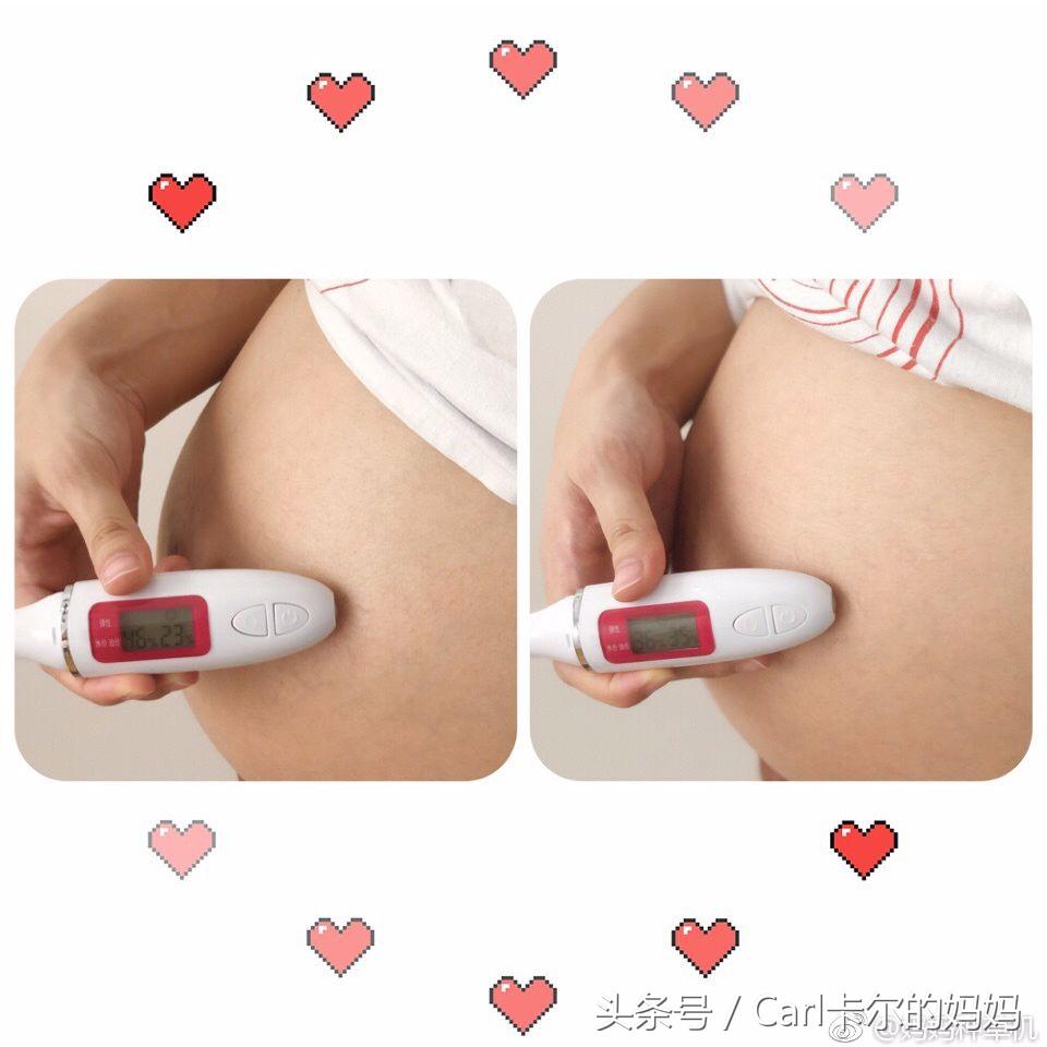 妊娠纹怎么预防和控制,妊娠纹如何预防