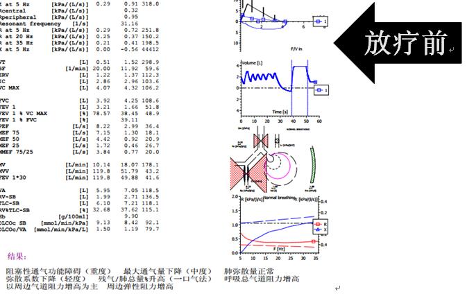 安罗替尼治小细胞肺癌吗,卡瑞利珠能治小细胞肺癌吗