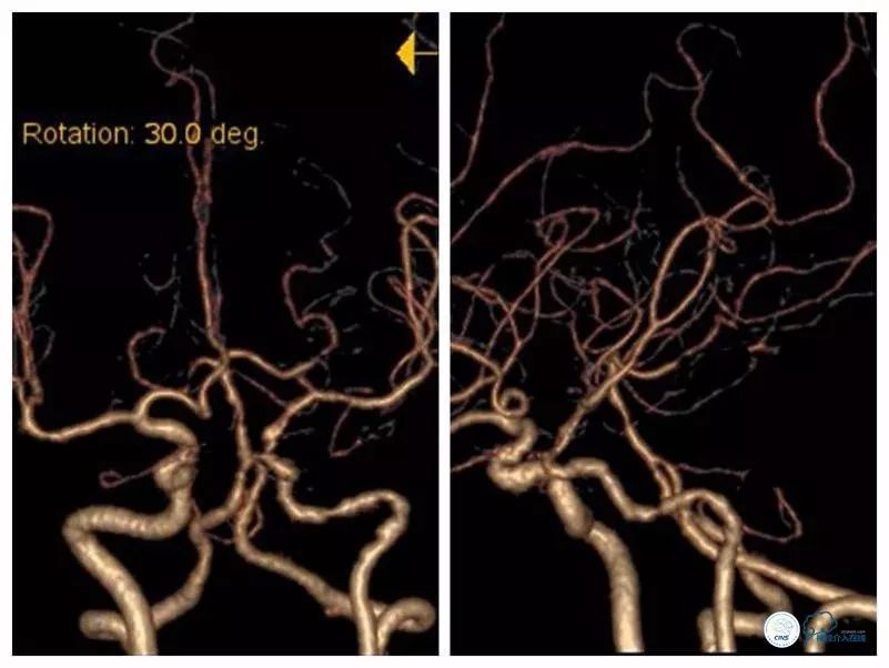 颈内动脉c5到c7段狭窄微创手术,天坛医院住院日记