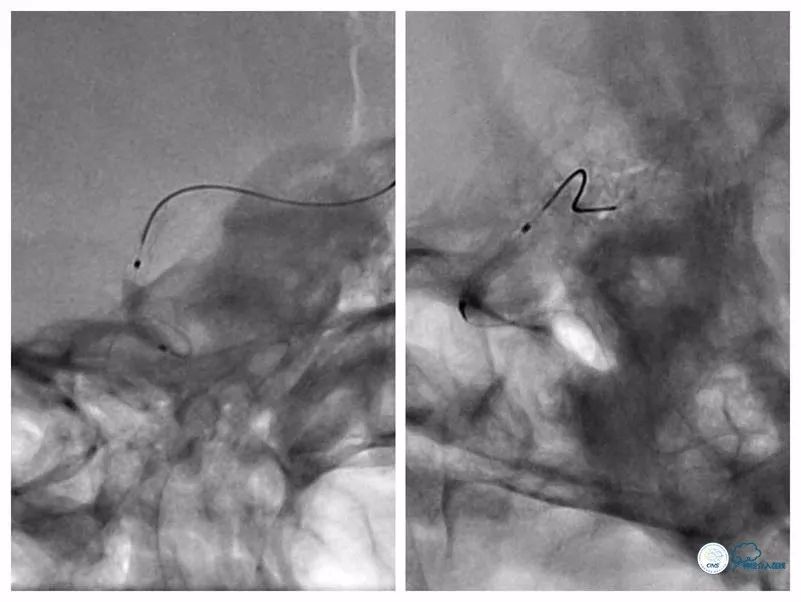 颈内动脉c5到c7段狭窄微创手术,天坛医院住院日记