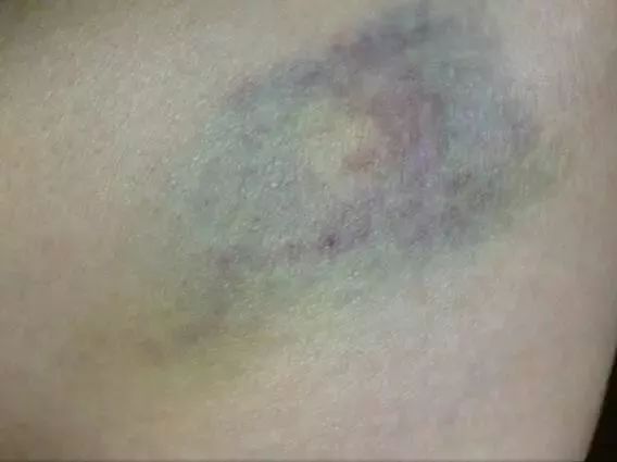 身上不明原因出现淤青是怎么回事,鬼捏青与正常淤青区别