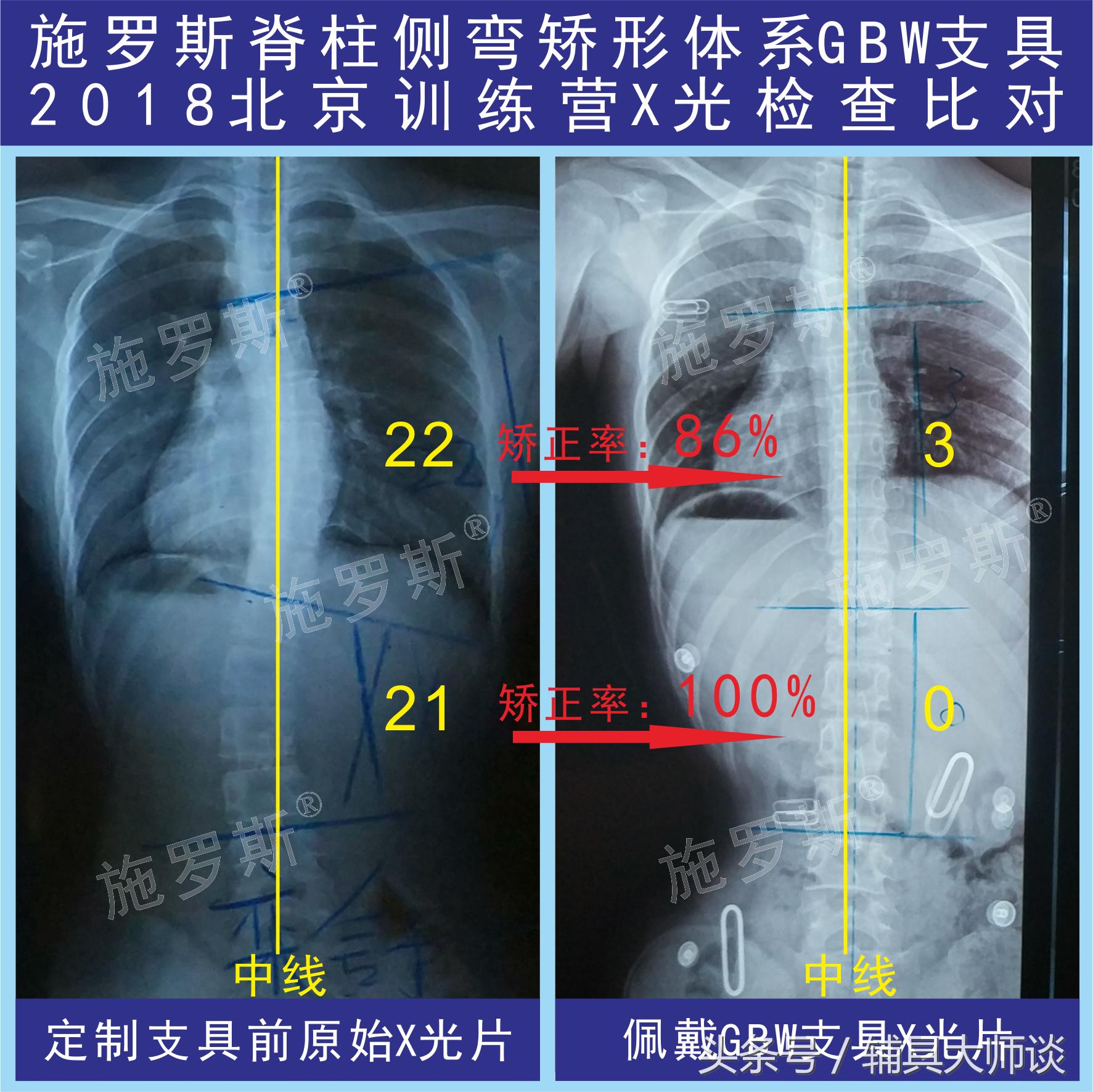 德国gbw支具侧弯60度适合吗,德国gbw支具北京哪里可以订