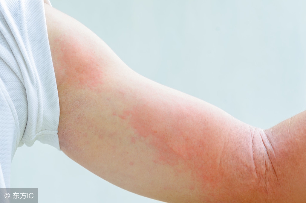 孩子麻疹反复是怎么回事,宝宝慢性荨麻疹多久才自愈