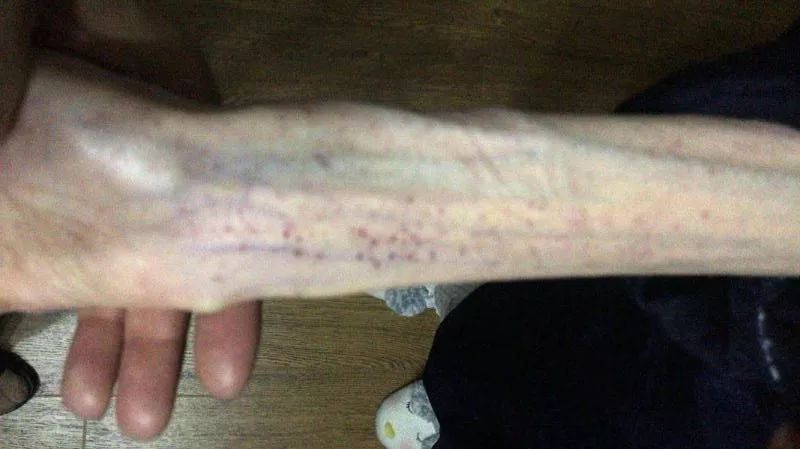 1米67才50斤!21岁女孩“自杀式减肥”,照片不忍直视……