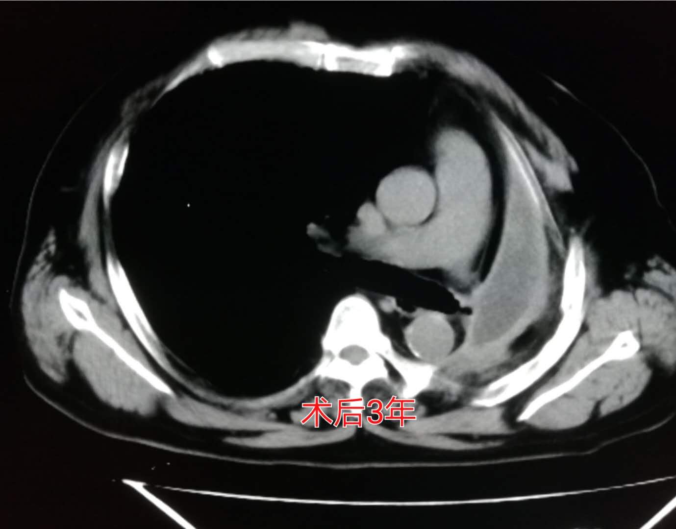 肺癌手术后胸腔内有碎肉怎么办,肺癌切除手术后有个空腔