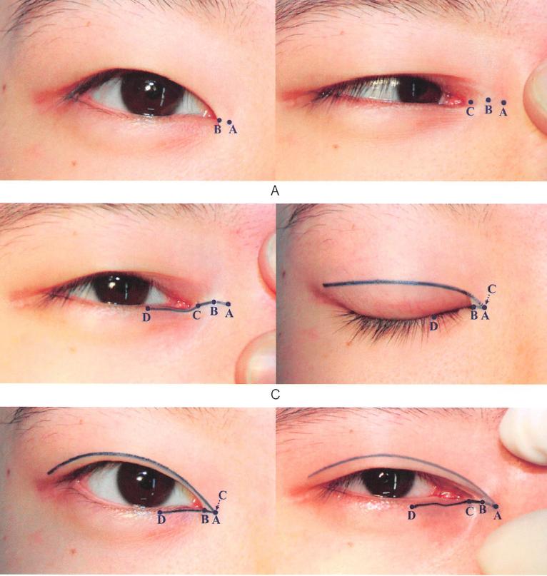 内眦赘皮要去整形医院吗,内眦赘皮怎么整形