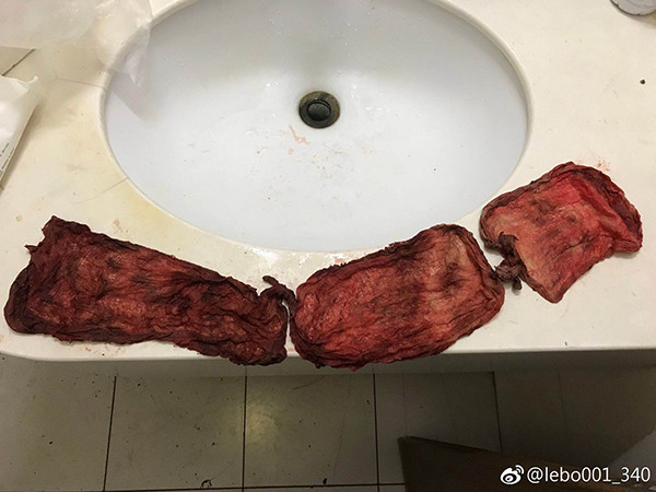 剖腹产北大人民医院,北大人民医院剖腹产