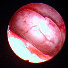 妇科专家教你认识宫腔镜,科普妇科专家带你认识宫腔镜