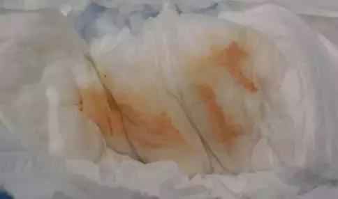 刚出生女宝宝尿布上有血啥原因,女婴尿布上有血迹家长没有在意