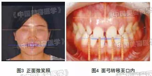 牙齿缝隙太大怎么补救吃什么,牙齿缝隙太大怎么快速补救