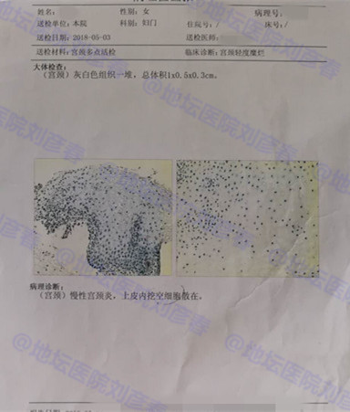 hpv感染宫颈炎如何能彻底治愈,宫颈hpv感染是不是就治不好了呀