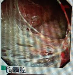 胸水抽了为什么还呼吸困难,胸水抽不出来了怎么回事