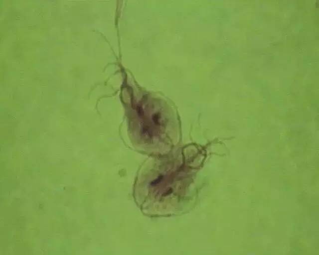 女子发烧十七天,女子发烧21天