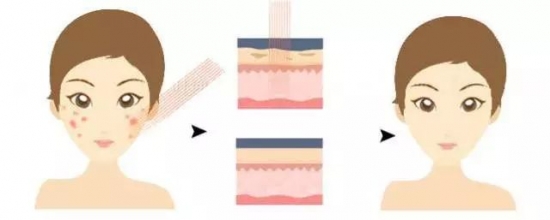 脸上有坑不是痘印怎么办,脸上的痘坑痘印怎么消除