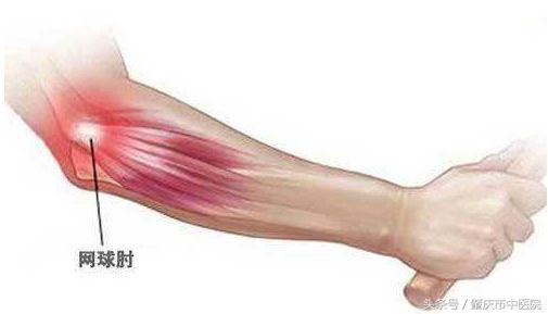 网球肘肌肉酸痛怎么治疗,网球肘部酸痛怎么治疗