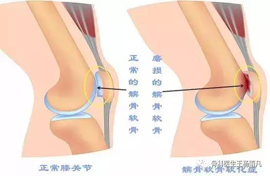 最新的人工膝关节使用寿命,膝关节使用说明