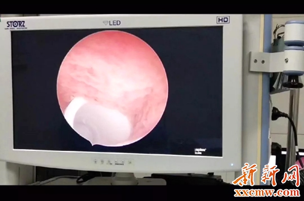 4岁女童阴道塞异物娄星区人民医院无创解难题