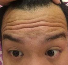 抬头纹与心血管疾病的关系,抬头纹越多心血管越大越好