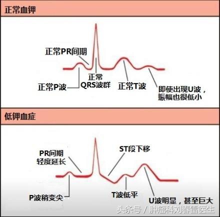 缺钾输液补钾的话几天能恢复正常,缺钾3.04严重吗需要补钾吗