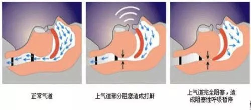 科普知识打鼾对心血管健康的危害,科普健康打呼噜