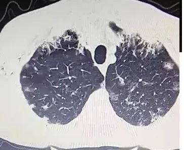 每日咳嗽是什么原因,每日咳痰