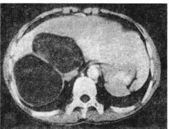 每日咳嗽是什么原因,每日咳痰