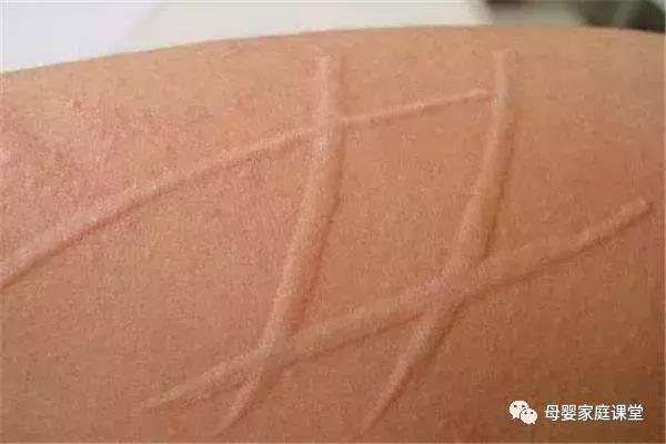 孕妇产后荨麻疹怎么治,孕妇麻疹的最佳治疗方法